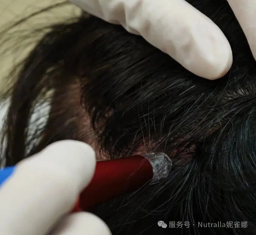 海南皮肤病医院引入妮雀娜一站式生发方案，系统性疗法定义生发高标准